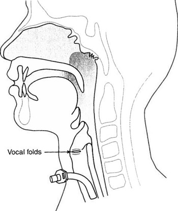 Trach tube in situ